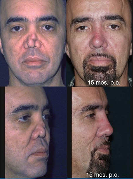 Nose job 01